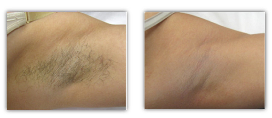 EFB - Anthélia IPL+ Laser Hair Removal & Skin Rejuvenation Machine