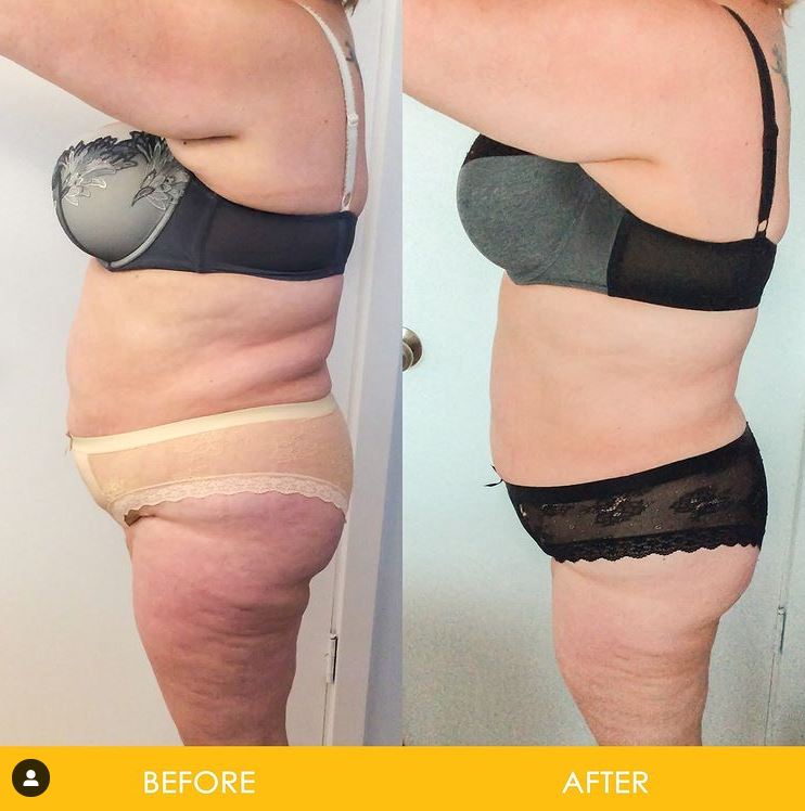 StarBody DX Twin Body-Sculpting Machine