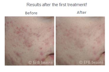 EFB - Adéna IPL & Photo-Rejuvenation Machine