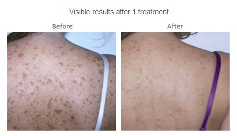 EFB - Anthélia IPL+ Laser Hair Removal & Skin Rejuvenation Machine