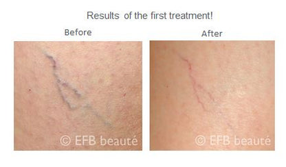 EFB - Anthélia IPL+ Laser Hair Removal & Skin Rejuvenation Machine