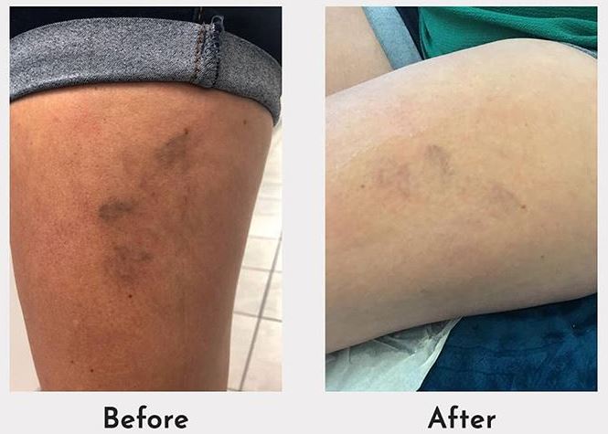 EFB - Anthélia IPL+ Laser Hair Removal & Skin Rejuvenation Machine